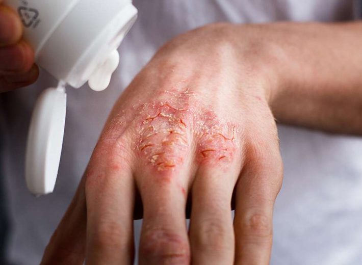 eczema-tips-treatments